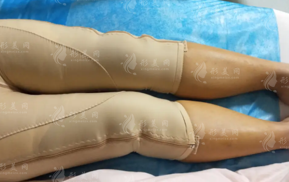 大腿吸脂要分多次進(jìn)行嗎？大腿吸脂后多久可以正常外出？