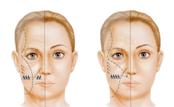 內(nèi)窺鏡拉皮手術(shù)多少錢？和普通拉皮有哪些區(qū)別？