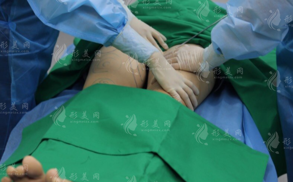 想瘦大腿，做吸脂怎么樣？腿部吸脂適合的人有哪些？