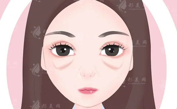 去眼袋失??？對(duì)應(yīng)不同情況，眼袋修復(fù)手術(shù)讓你找回本屬于自己的美！