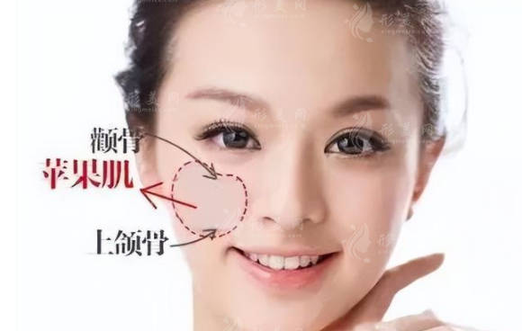 你適合填充蘋果肌嗎？蘋果肌和顴骨怎么區(qū)分？