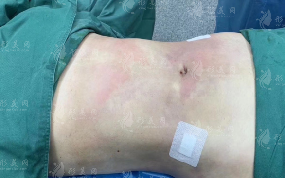 腰腹環(huán)吸會(huì)反彈嗎？收費(fèi)價(jià)格貴嗎？