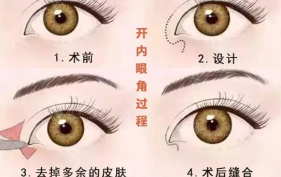 開(kāi)眼角和割雙眼皮有什么區(qū)別呢？開(kāi)眼角術(shù)后需要注意哪些呢？