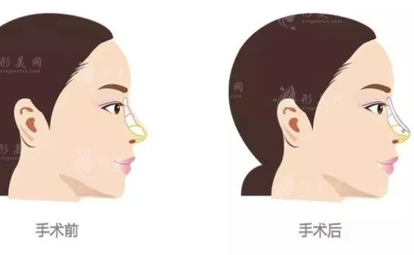 重慶藝星整形隆鼻怎么樣？人氣醫(yī)生介紹、價格表預(yù)覽