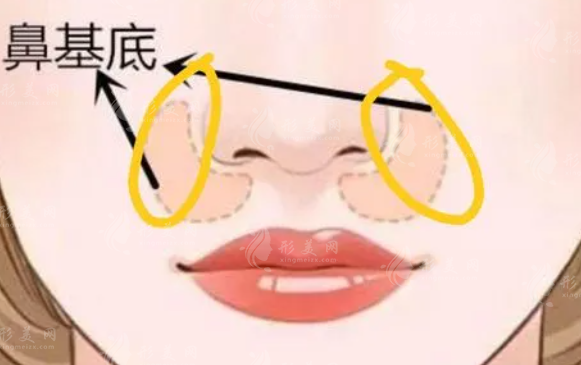 鼻基底填充玻尿酸有什么后遺癥？效果