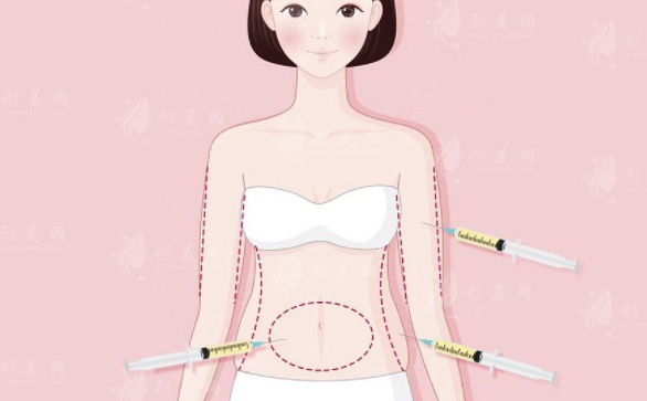 腰腹吸脂術(shù)的效果如何？吸脂術(shù)減肥會反彈嗎？