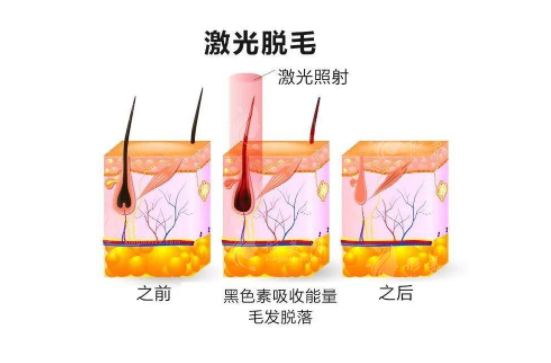 上海九院激光脫毛治療價格表