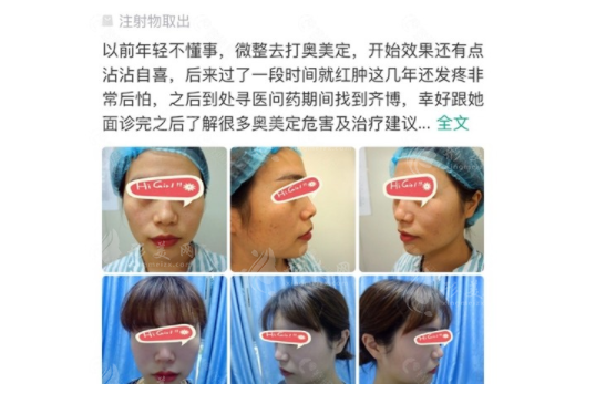 廣州荔灣區(qū)人民醫(yī)院異物取出怎么樣？