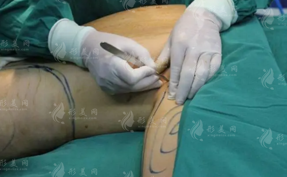 吸脂手術的抽取量是多少？塑身衣多長時間能看到效果？