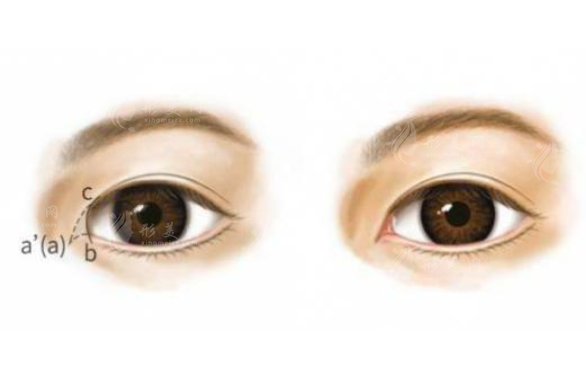 內(nèi)眥贅皮一定要開眼角嗎？收費價格貴嗎？