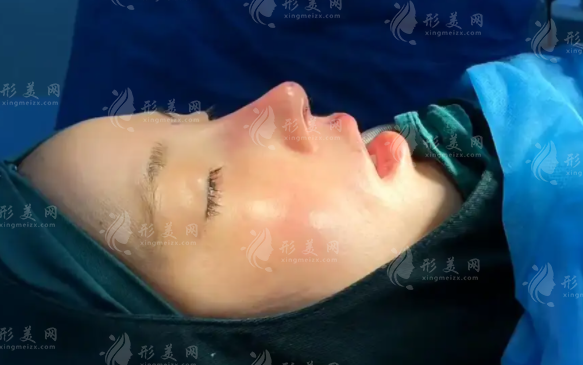 肋骨隆鼻手術(shù)可以維持多少年？會吸收嗎？