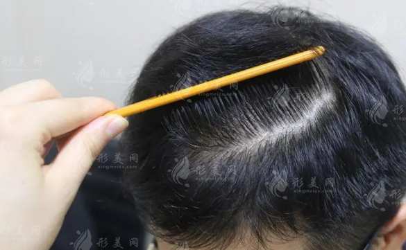 做完植發(fā)手術后多久可以上班？植發(fā)后可以染燙嗎？