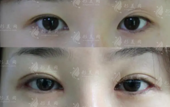 什么樣的雙眼皮需要被修復(fù)？如何修復(fù)呢？