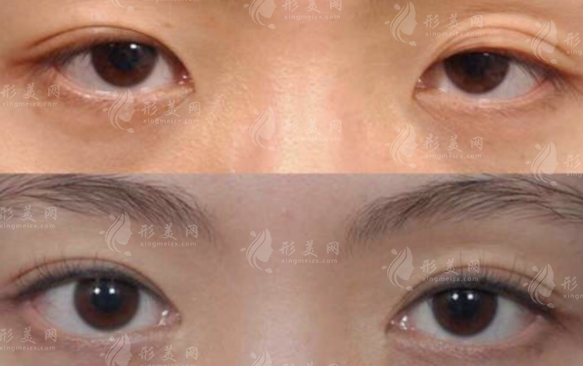 什么是上瞼提肌矯正手術(shù)？能解決什么問題？