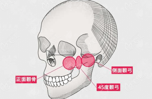 顴骨內(nèi)推手術(shù)出現(xiàn)的風(fēng)險有哪些?