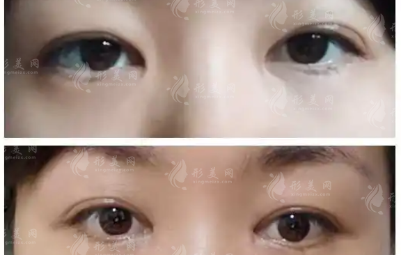 內(nèi)眥贅皮術(shù)會留疤嗎？需要多少錢？