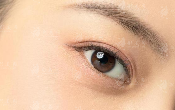 內(nèi)眥贅皮術(shù)會留疤嗎？需要多少錢？