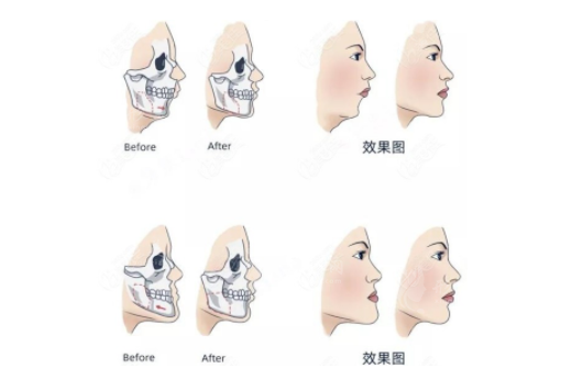什么是正頜正畸聯(lián)合治療?