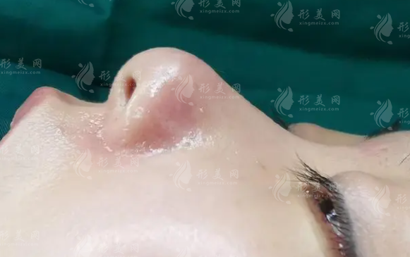 取耳軟骨隆鼻，耳朵會變塌？！耳軟骨隆鼻會被吸收嗎？