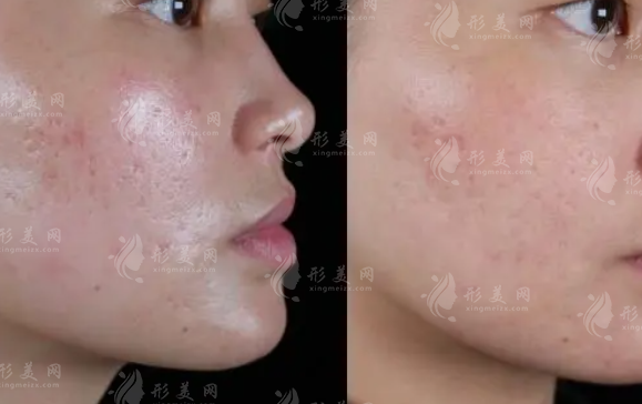 點(diǎn)陣激光祛痘坑多少錢一次？做幾次才有效果？