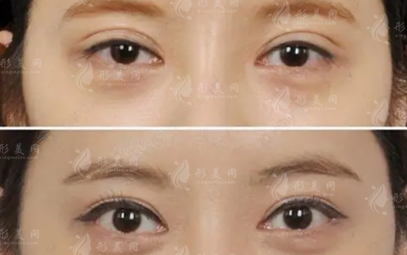 做雙眼皮修復(fù)多少錢？多久可以恢復(fù)自然？
