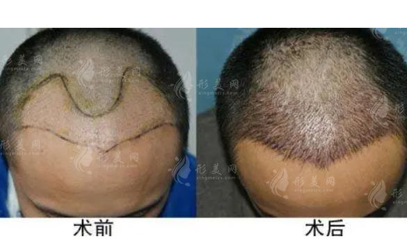 頭發(fā)移植效果能保持多久？手術(shù)有危險(xiǎn)嗎？