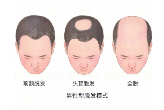 上海第九人民醫(yī)院植發(fā)掛什么科？多少錢？附吳巍醫(yī)生介紹