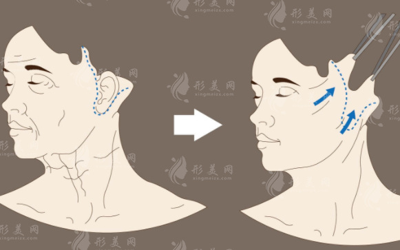 上海九院小拉皮手術(shù)一般多少錢？人氣醫(yī)生介紹、價格表全新匯總！
