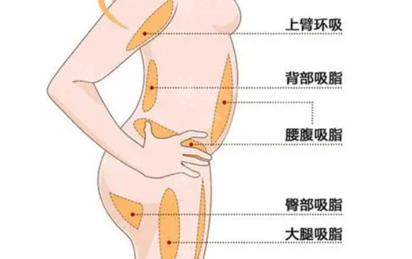 背部吸脂手術(shù)多少錢(qián)？手術(shù)效果靠譜嗎？