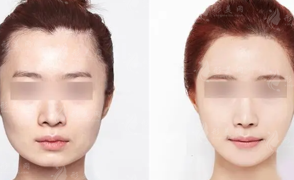 磨骨瘦臉大概多少錢？貴嗎？