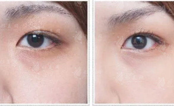 光子去黑眼圈多少錢？項(xiàng)目對(duì)眼睛有害嗎？