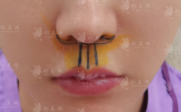 人中縮短術(shù)會(huì)留疤嗎？具體價(jià)格需要多少？