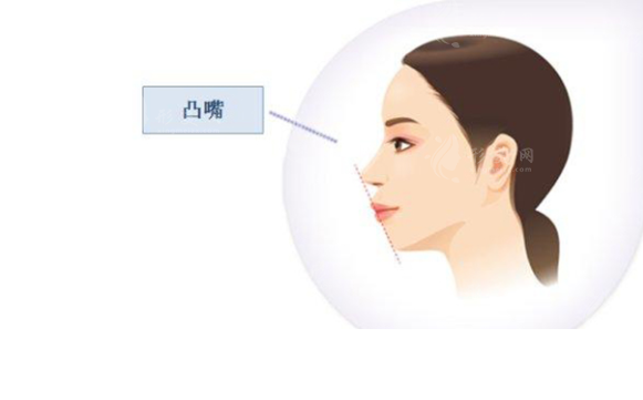 突嘴可以矯正過來嗎？需要多少錢？