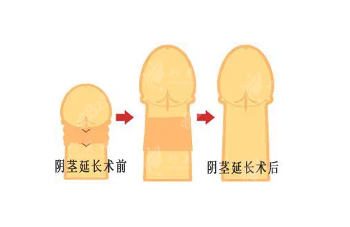 重慶星榮整形醫(yī)院李世榮做延長(zhǎng)手術(shù)厲害嗎？提升持久延長(zhǎng)+增粗