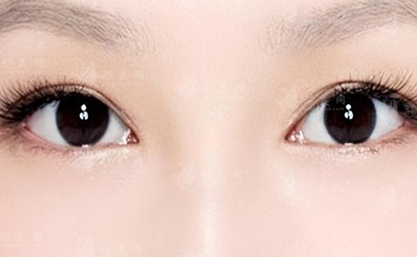 割雙眼皮多久能恢復(fù)正常？術(shù)前術(shù)后注意事項(xiàng)有哪些？