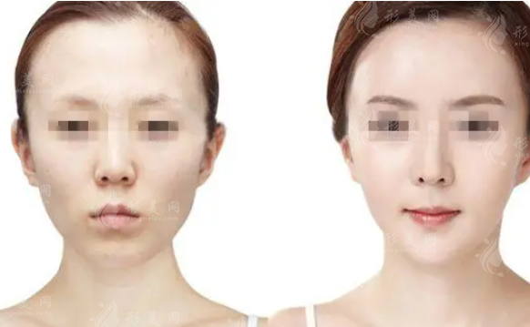 全臉脂肪填充大概要多少錢？多久能恢復(fù)自然？