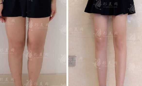大腿抽脂后有硬塊正常嗎？多久會(huì)消失？