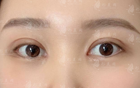 定點(diǎn)雙眼皮能維持幾年？手術(shù)效果美滋滋~