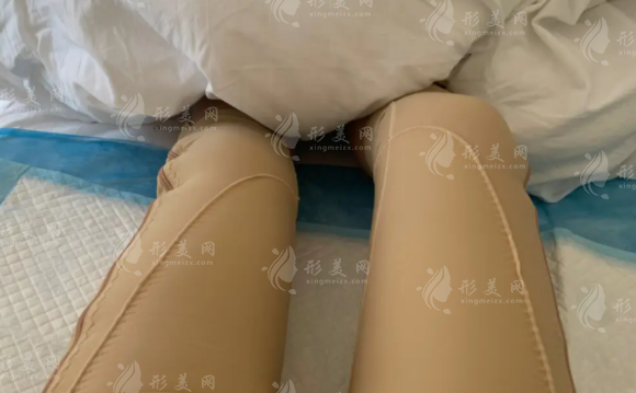 大腿吸脂恢復(fù)時(shí)間是多久?術(shù)后護(hù)理小知識(shí)~