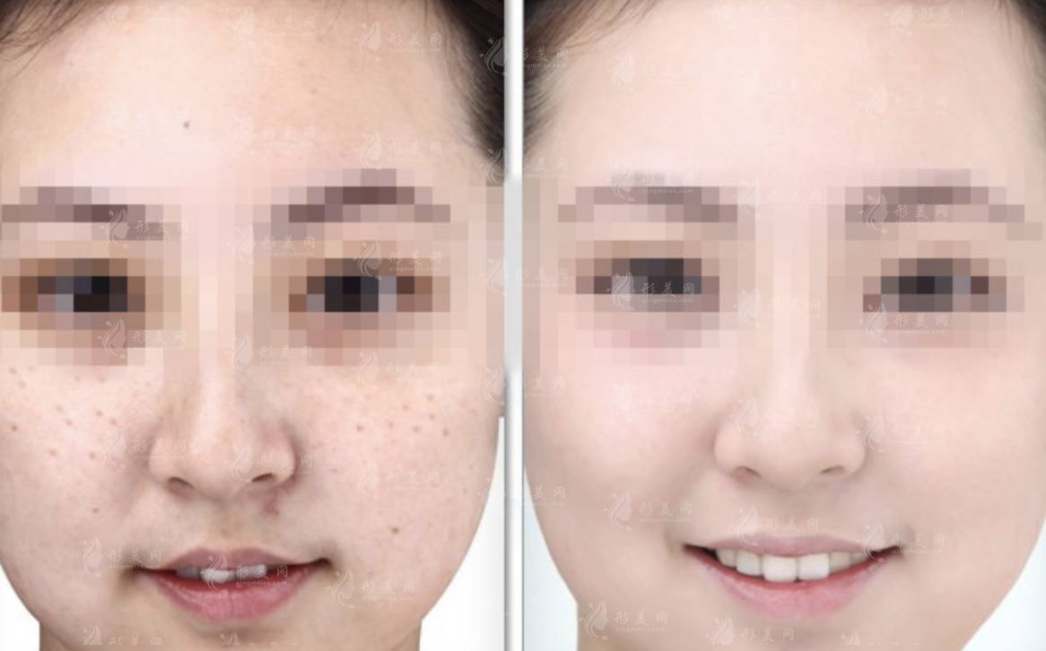 彩光去雀斑需要做幾次?做一次需要多少錢呢?
