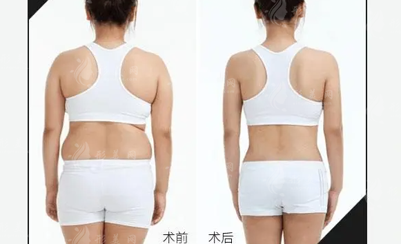 背部吸脂的手術(shù)方法及原理，瘦身效果真的好突出~