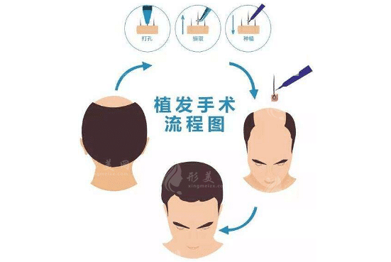 北京八大處整形蔣文杰怎么樣？植發(fā)技術&收費價格表
