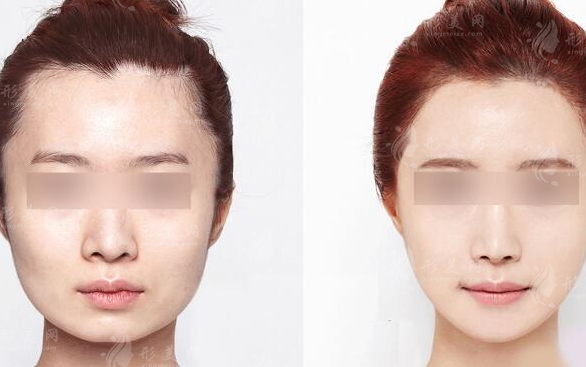 磨骨瘦臉效果怎么樣?多久才能恢復(fù)自然？