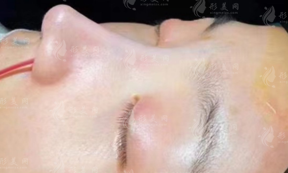 超肋骨隆鼻是什么材料?塑造自然小翹鼻~