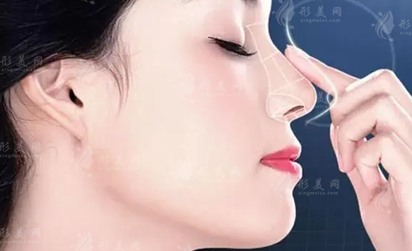 注射隆鼻好還是做假體好？內(nèi)附手術(shù)介紹