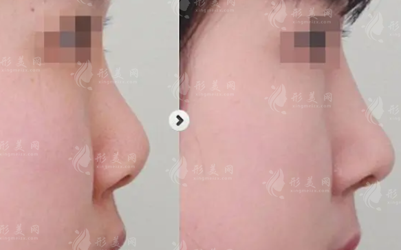 隆鼻用的假體需要更換嗎,可以用多少年?