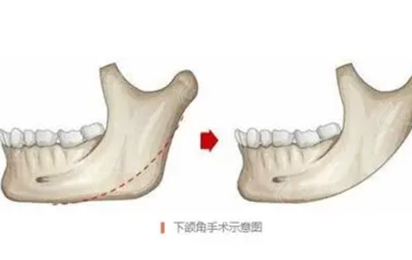 下頜角磨骨術(shù)恢復(fù)時(shí)間大概是多久？