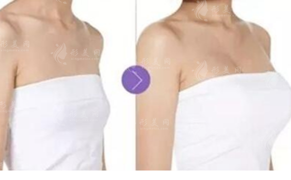 下垂乳房能改良嗎？下垂乳房怎么有改良？