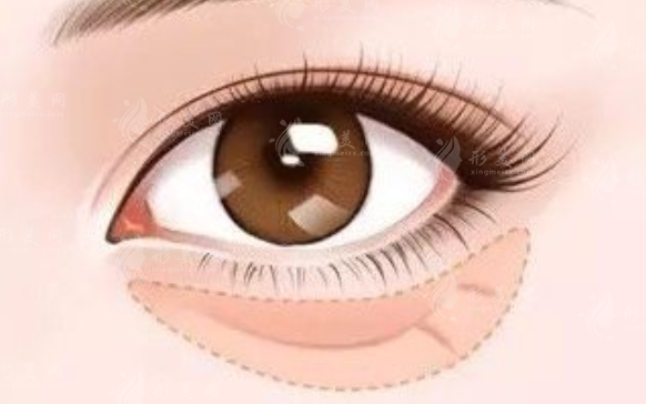微創(chuàng)內(nèi)切去眼袋手術怎么樣？
