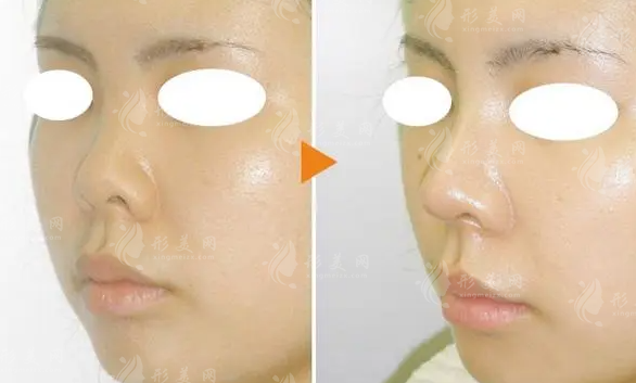 假體隆鼻后會不會變形呢?術后會出現(xiàn)外露移位嗎?